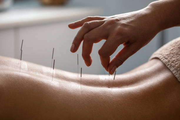 Acupuncture specialist inserting needle into patient's back due treatment. She is stimulating energy flow through the body for faster relaxation and recovery.